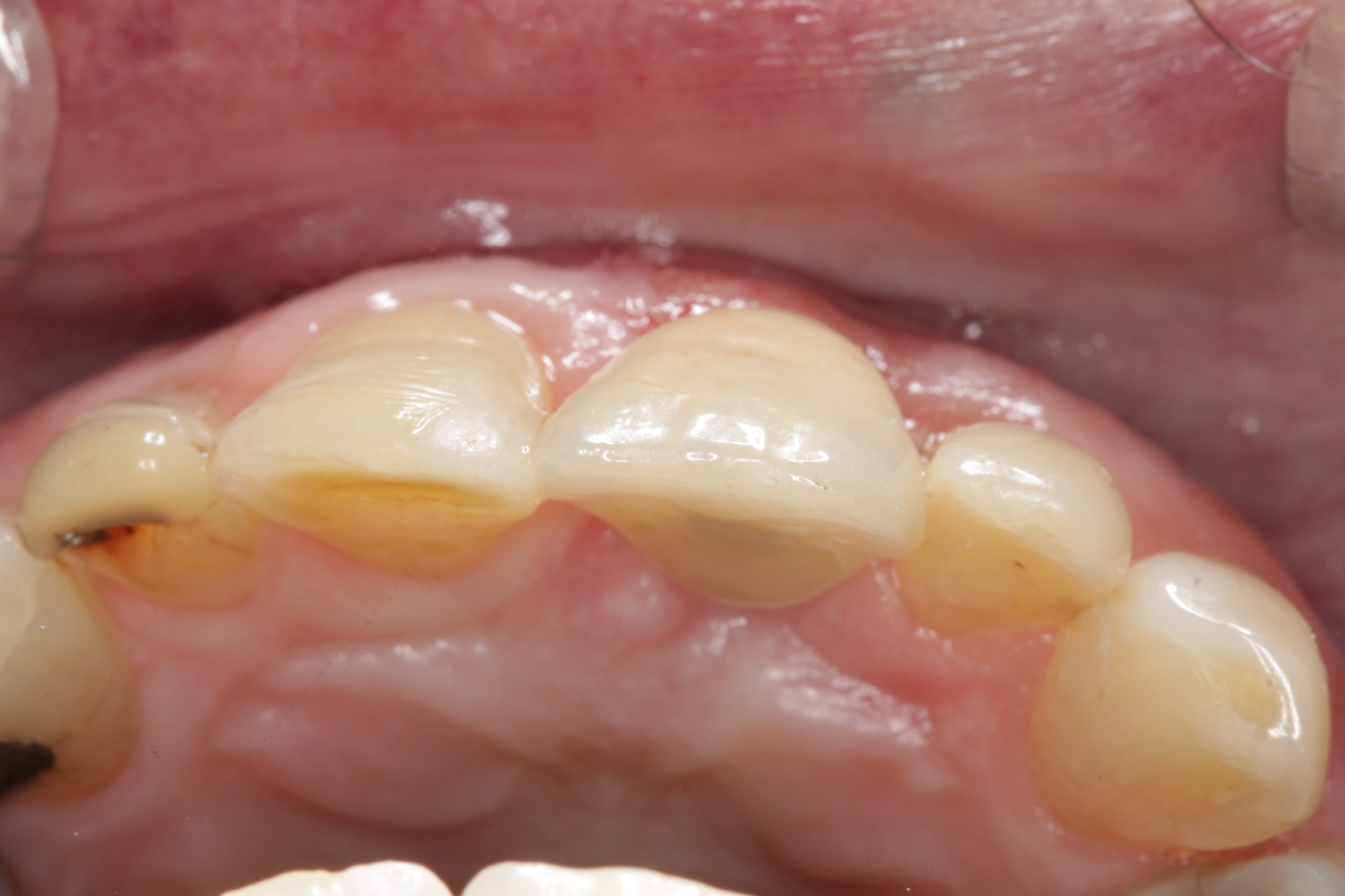 After-Occlusal-scaled