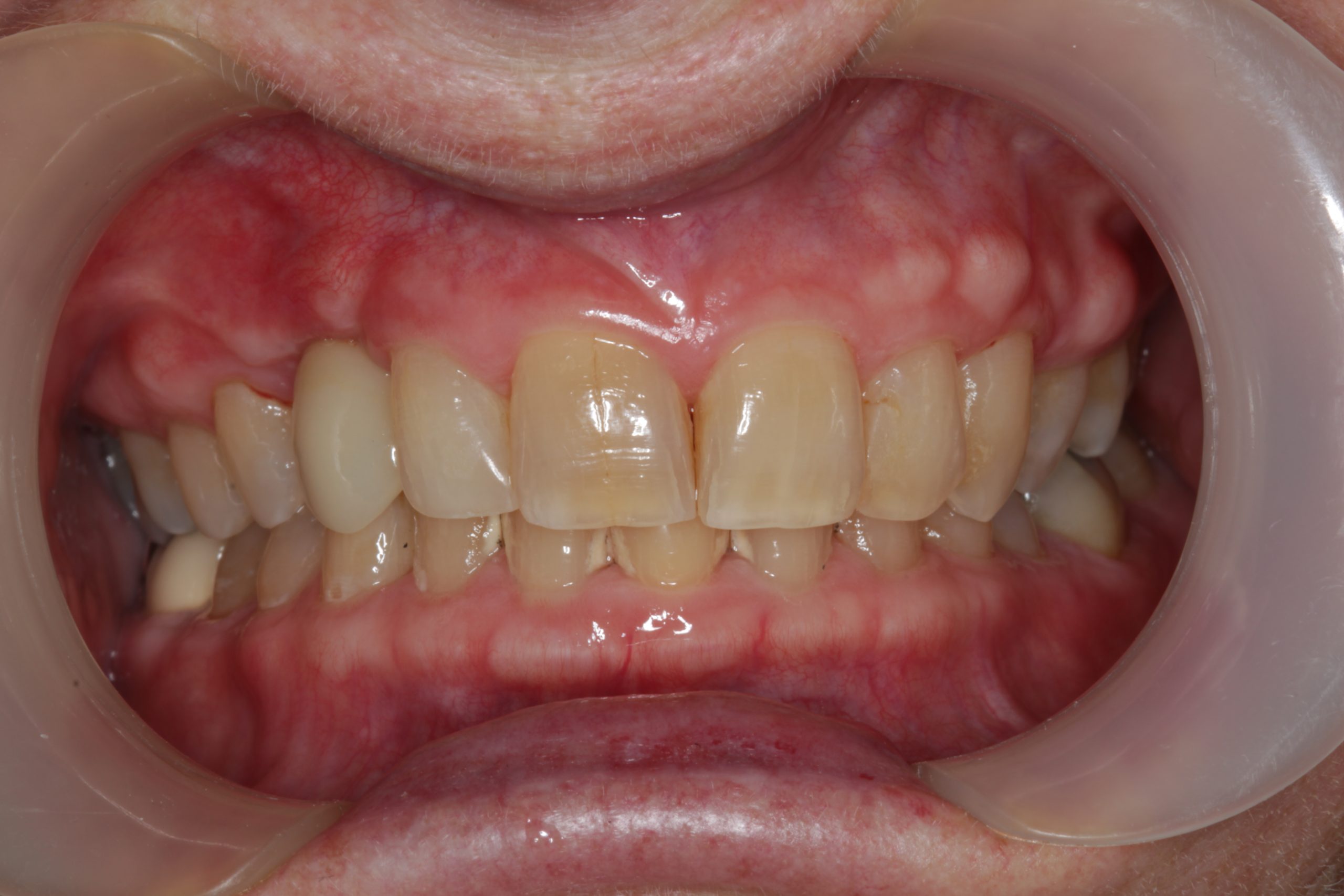 After-frontal-retracted-1-scaled