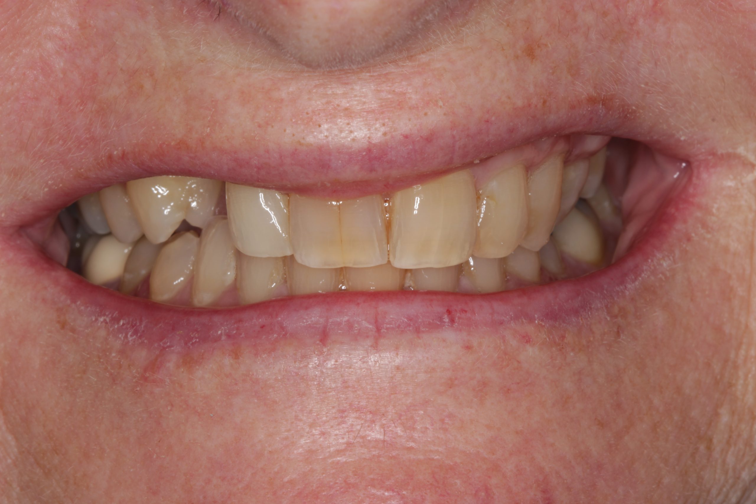 Before-Smiling-scaled