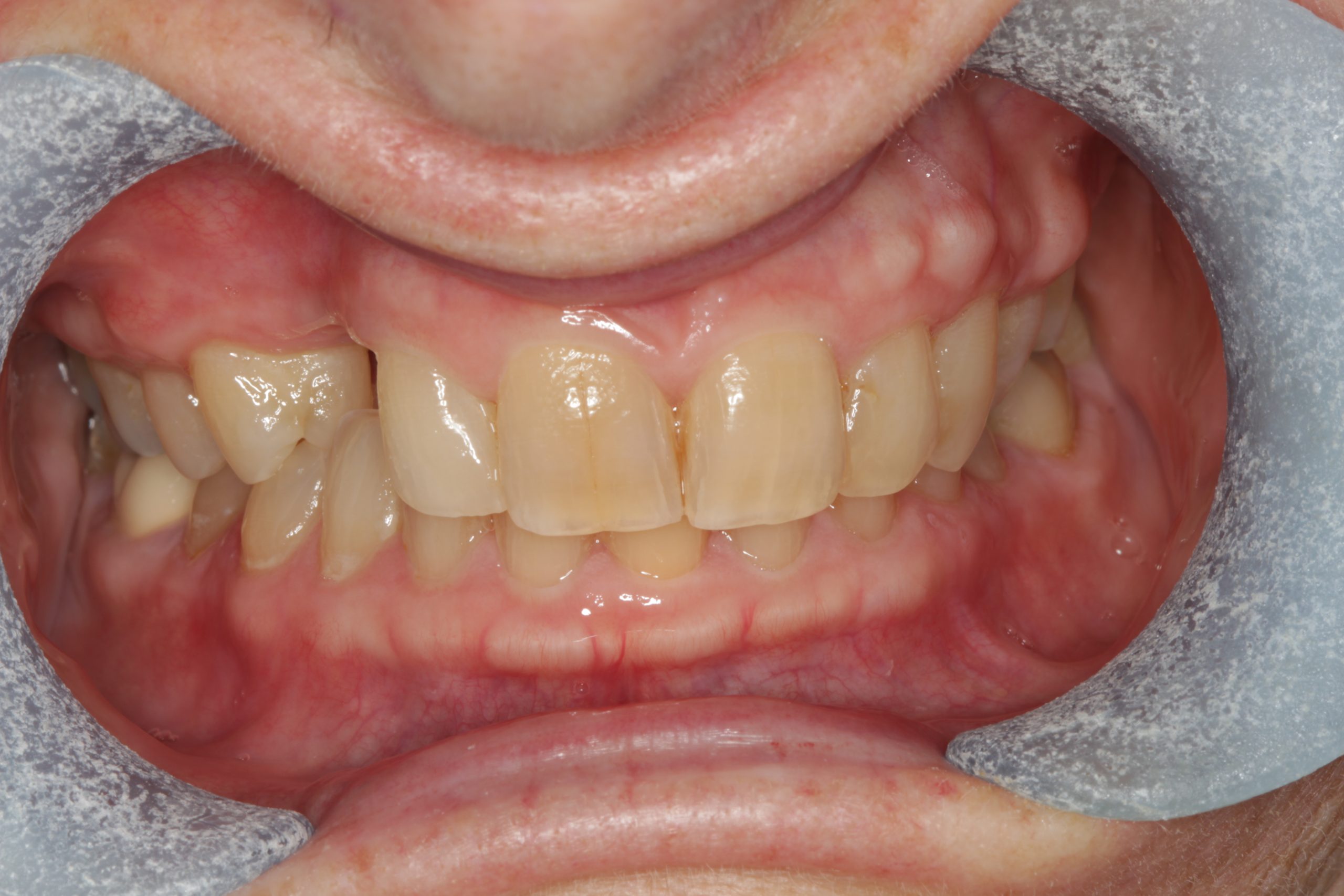 Before-frontal-retracted-scaled