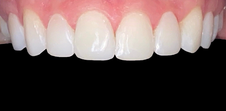 composite-bonding-1-after