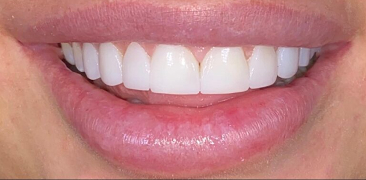 composite-bonding-1-after