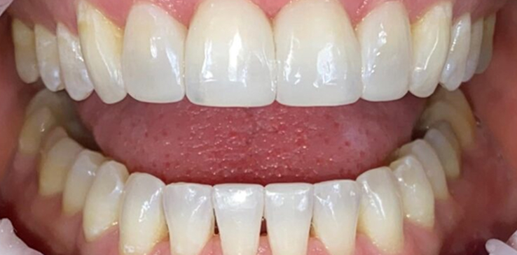 composite-bonding-1-after