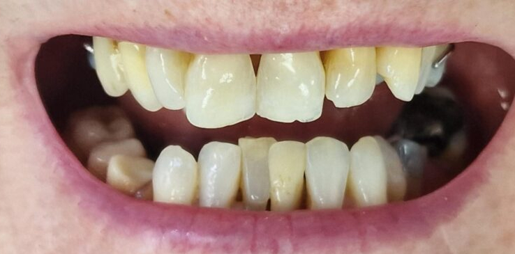 composite-bonding-1-before