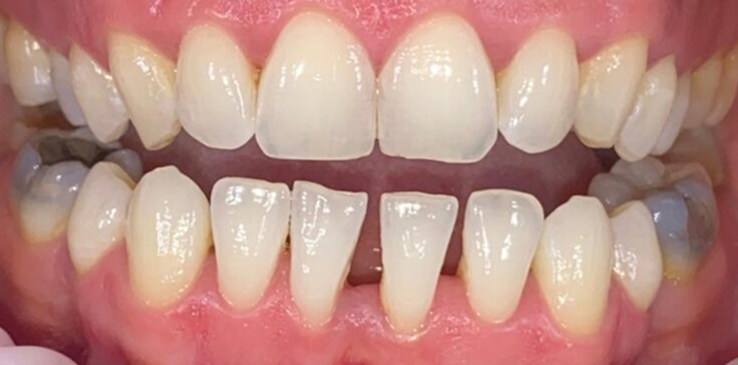 composite-bonding-1-before