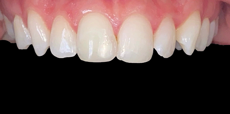 composite-bonding-1-before