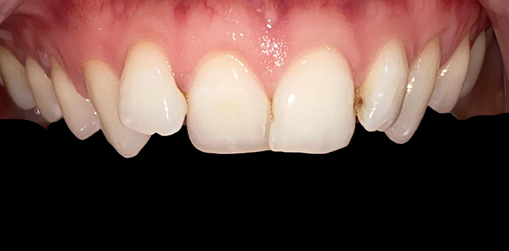 composite-bonding-1-before