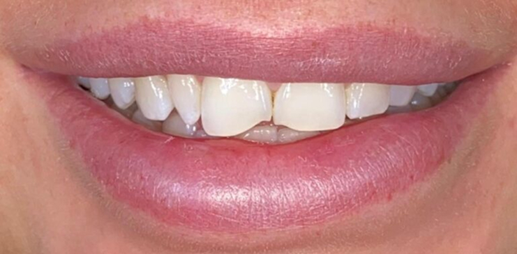 composite-bonding-1-before