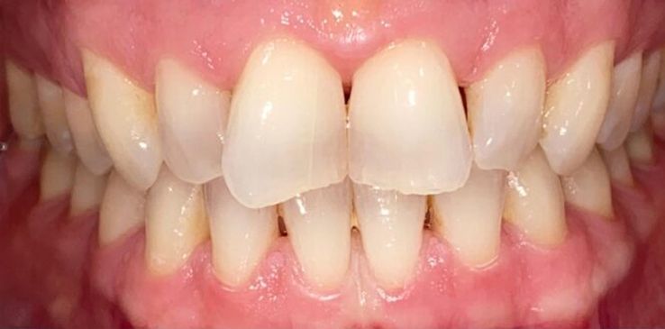 composite-bonding-1-before