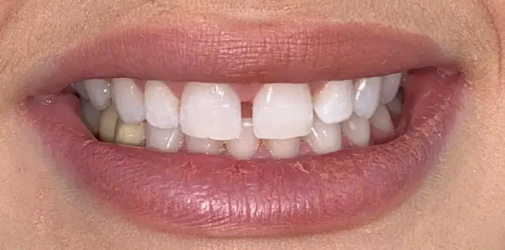 composite-bonding-1-before