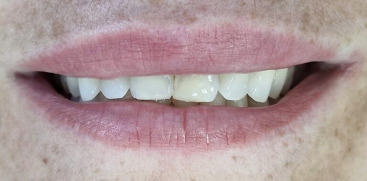 porcelain-veneers-before